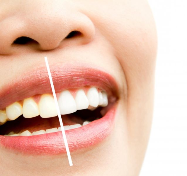 bleaching dental