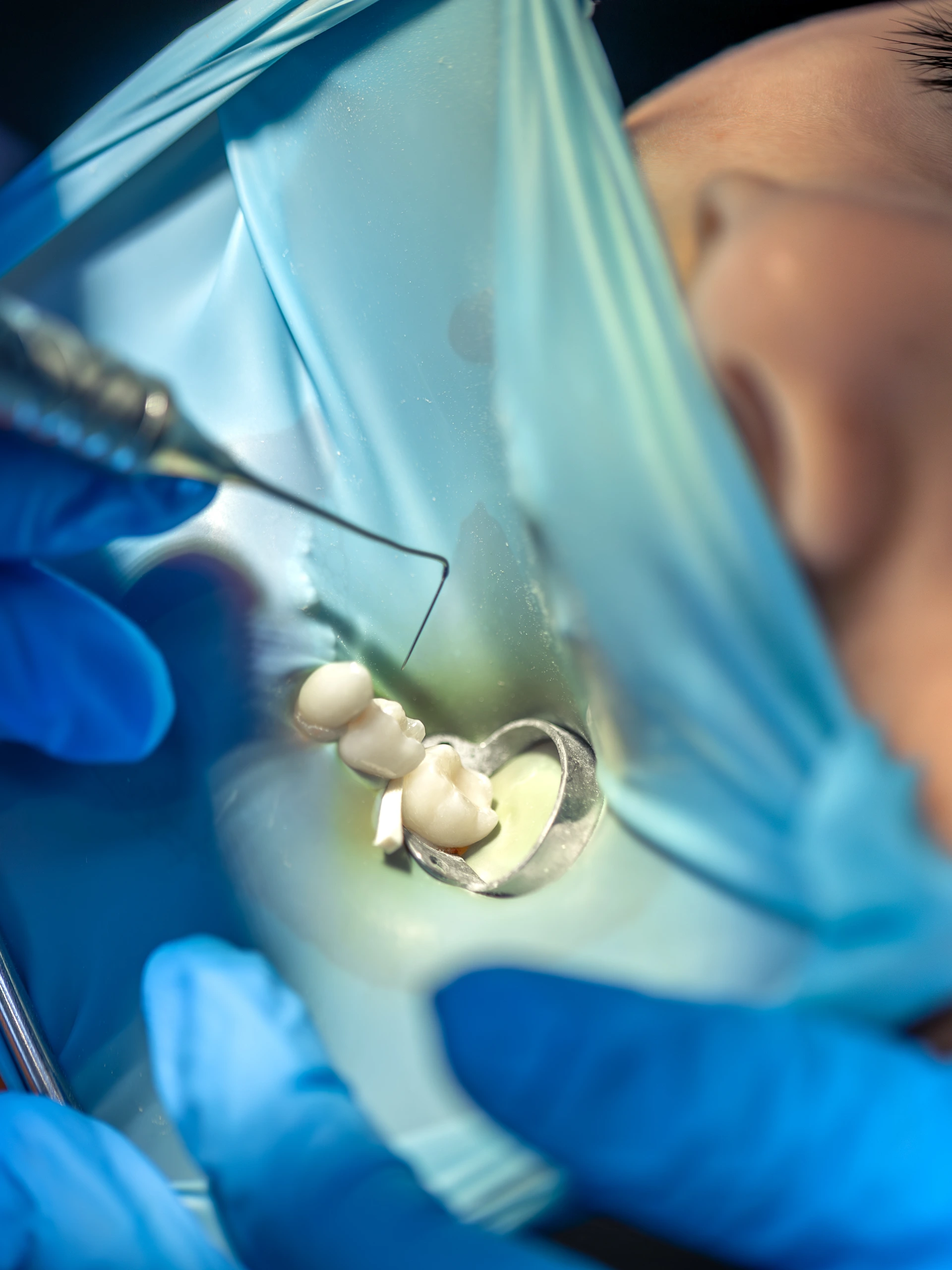 Our GIC Restorations Procedure